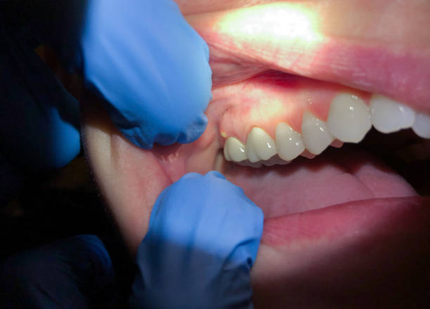 Best Emergency Gum Treatment in Wedgefield, SC